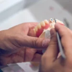 Γέφυρες δοντιών: Μία αξιόπιστη λύση για την αντικατάσταση χαμένων δοντιών